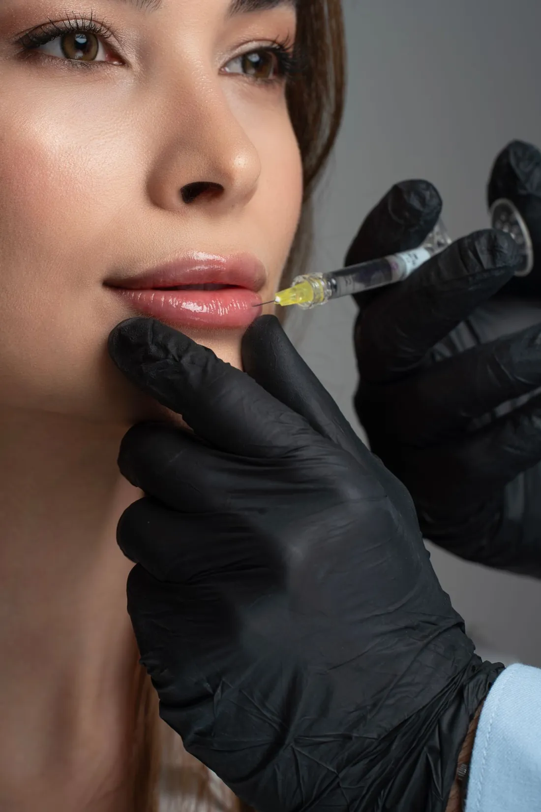 Lip enhancement with dermal filler